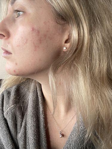 Cleared my breakouts!